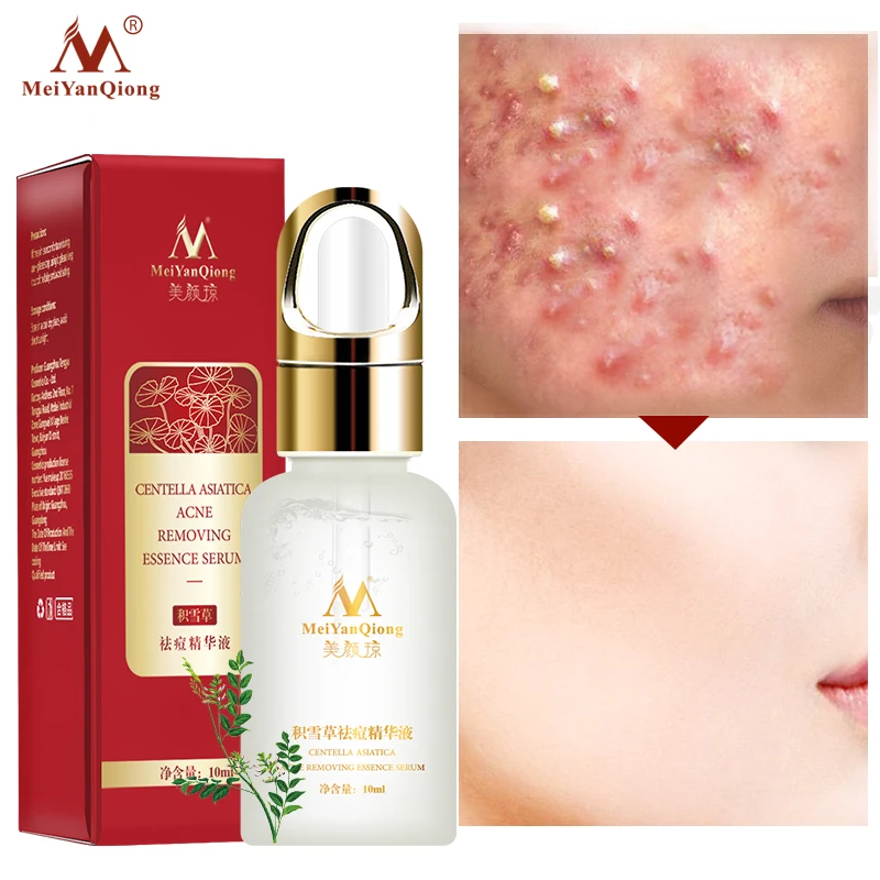 

Centella Asiatica Acne Removing Essence Serum Remove Acne To Eliminate Acne Marks And Control Oil To Enhance Whiten Skin