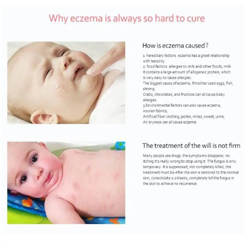 YIGANERJING Pruritus dermitis крем для тела псориаз Dermatitis Eczema натуральная мазь детей и