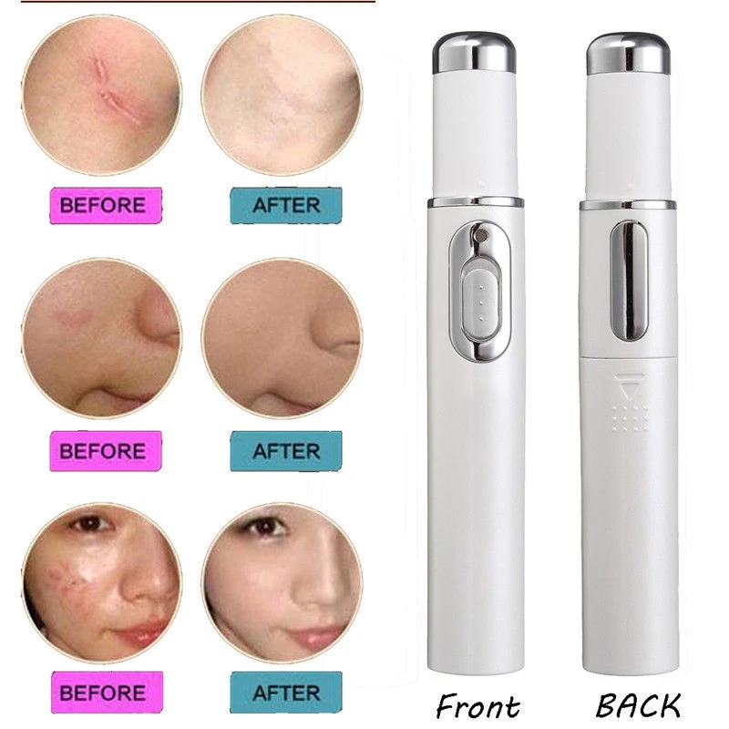 

Acne Laser Pen Portable Anti-Wrinkle Machine Durable Soft Scar Remover Device Blue Light Laser Varicose Veins Therapy Pen
