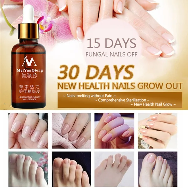 

Hot sale Nail Treatment Feet Care Essence Nails Foot Whitening Toe Fungus Removal Nail Gel