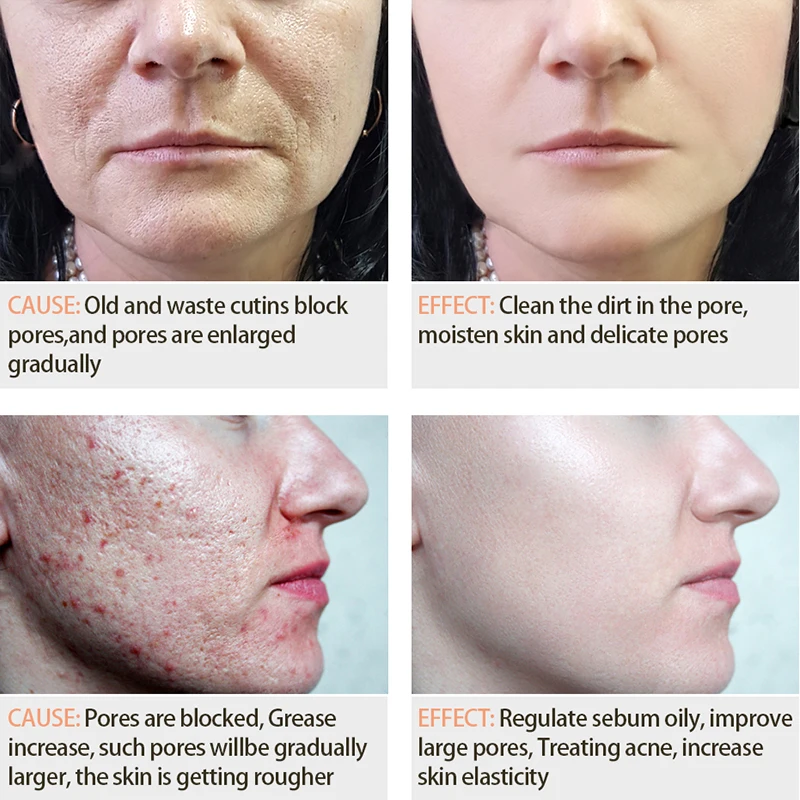 Яркая Гламурная acide salicylique Сыворотка для лица сужающая поры увлажняющая