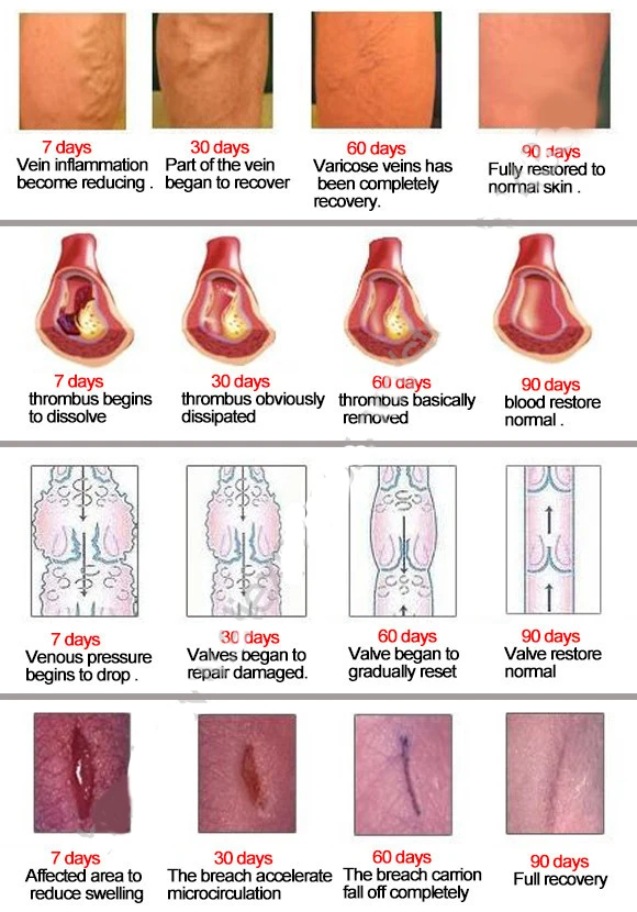10 упаковок варикозности медицинский препарат против варикозного расшрения вен крем лечение против васкулита ног Phlebitis травяной продукт медицинский пластырь