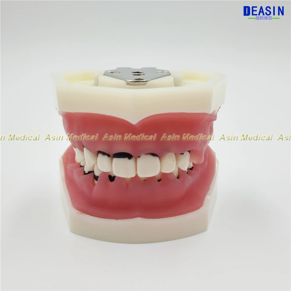 Modelo de Aprendizagem Modelo de Doença Deasin Novo Dentista Periodontal Dente - Modelo Médico 2 Cheap Clareamento dos dentes