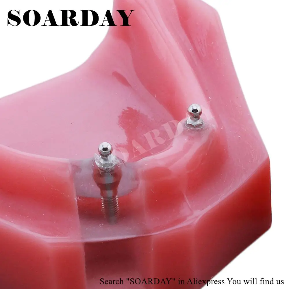 SOARDAY Overdenture уступает с 2 имплантами зубной зуб зубы стоматолог стоматология анатомическая Стоматологическая модель