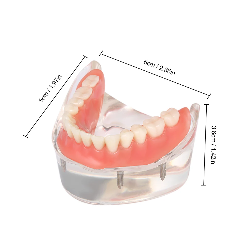 Стоматологическая Overdenture Стоматологическая модель зубов внутренняя mandibulal модель нижних зубов Mandibular с 4 восстановлением имплантата для зубов, зубная