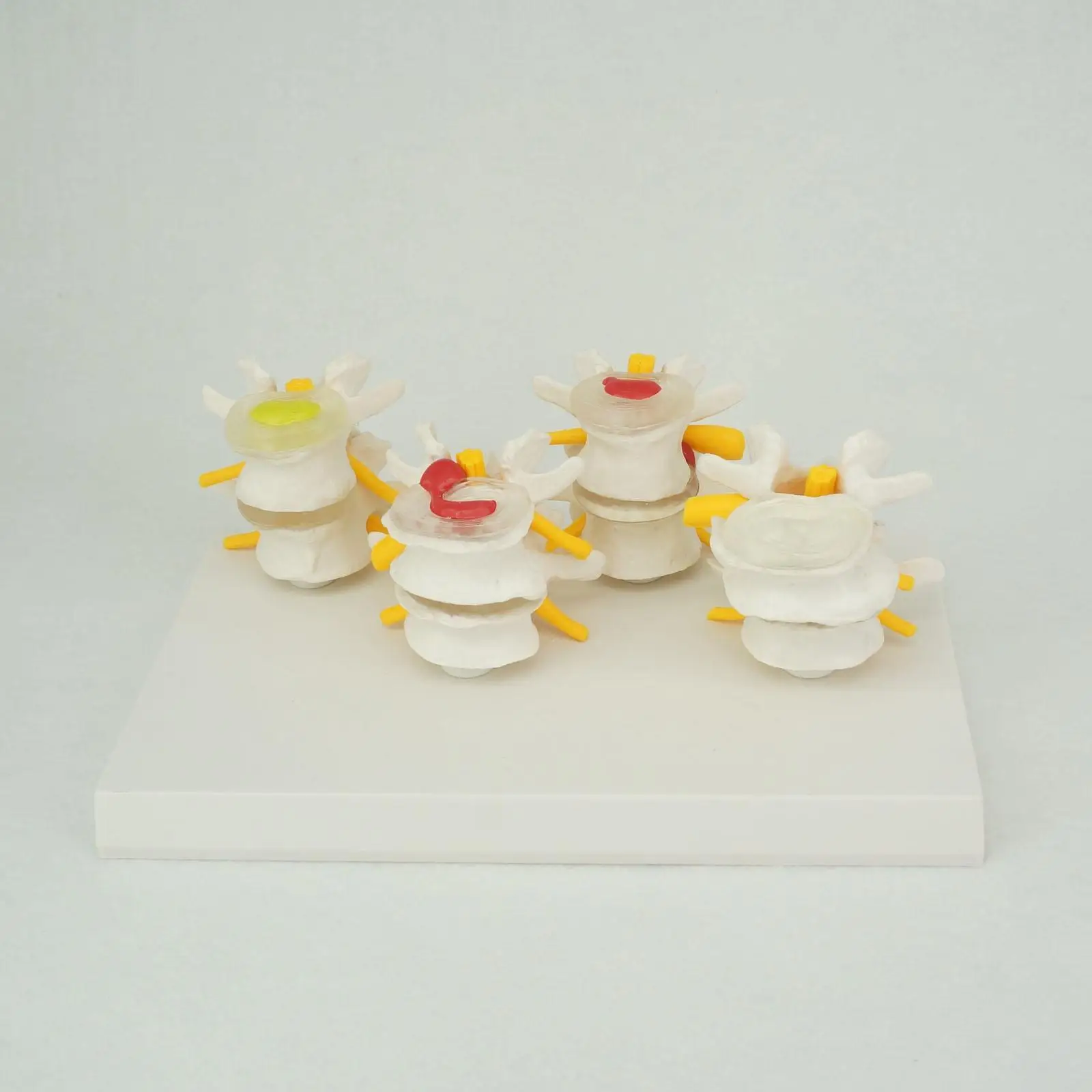 

PVC Anatomical Human Lumbar Vertebrae Degenerative Disc Disease Model Medical