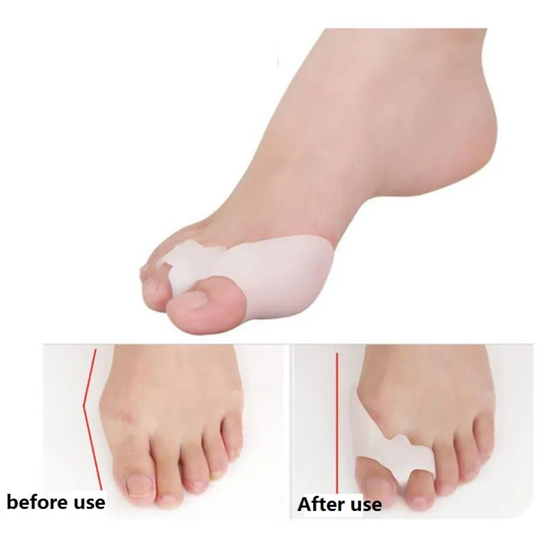 1 пара ног Поддержка силиконовый разделитель для большого пальца ...