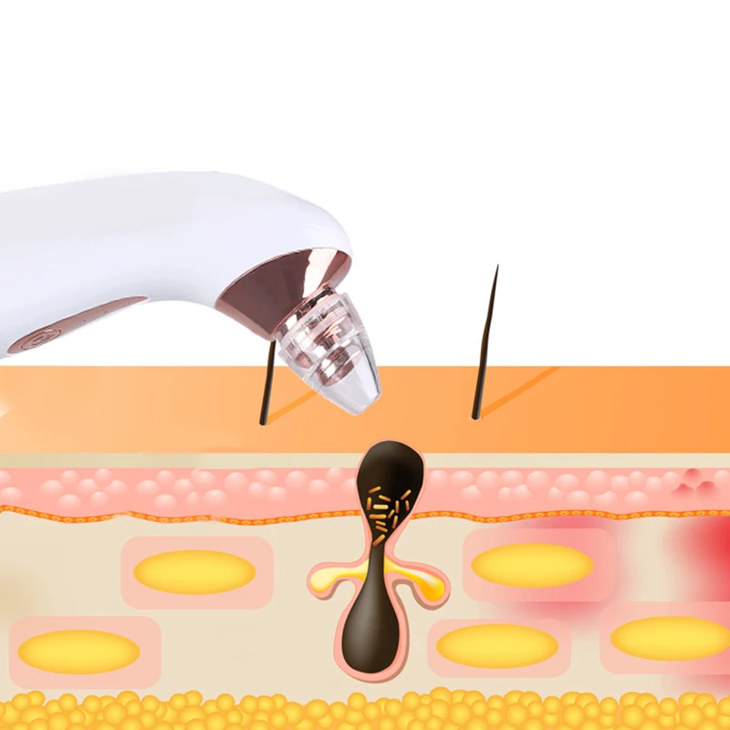 Средство для удаления черных точек пылесос вакуумные всасывающие поры кожи Удаление прыщей разглаживающий увлажняющий бытовой
