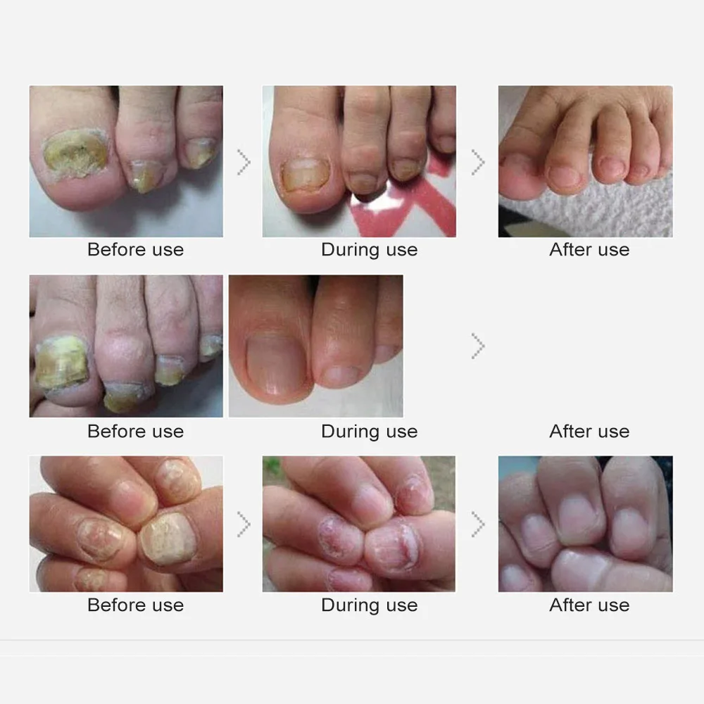 Ameizii 2*10 мл Лечение грибка для ногтей набор грибка стоп противогрибковые инфекция ногтей безопасные и эффективные ногти на руках, ногти на ногах уход решение
