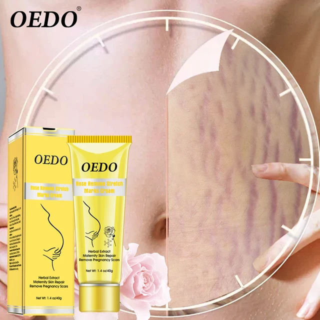cara menggunakan oedo rose remove stretch mark cream