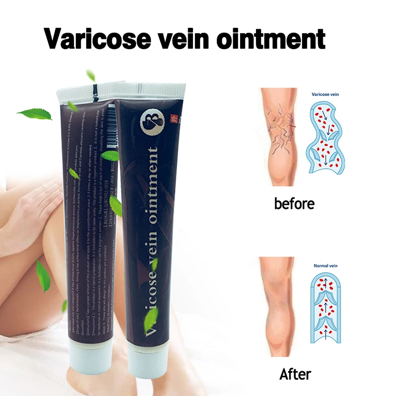 Варикозный крем против варикозного расширения вен лечение против васкулита ног Phlebitis травяной продукт медицинский пластырь