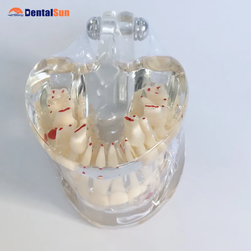 Стоматологический ортодонтический модель/прозрачные смешанные возраст модель ортодонтический, для зубов Модель HST-C5