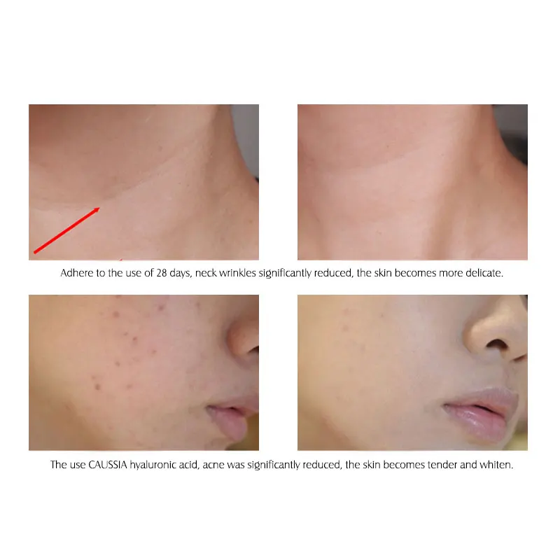 ARTISCARE Hyaluronic Acid Face Serum 5pcs for Moisturizing and  Brighten Long-Lasting Hydrating Skin Care Essence 4