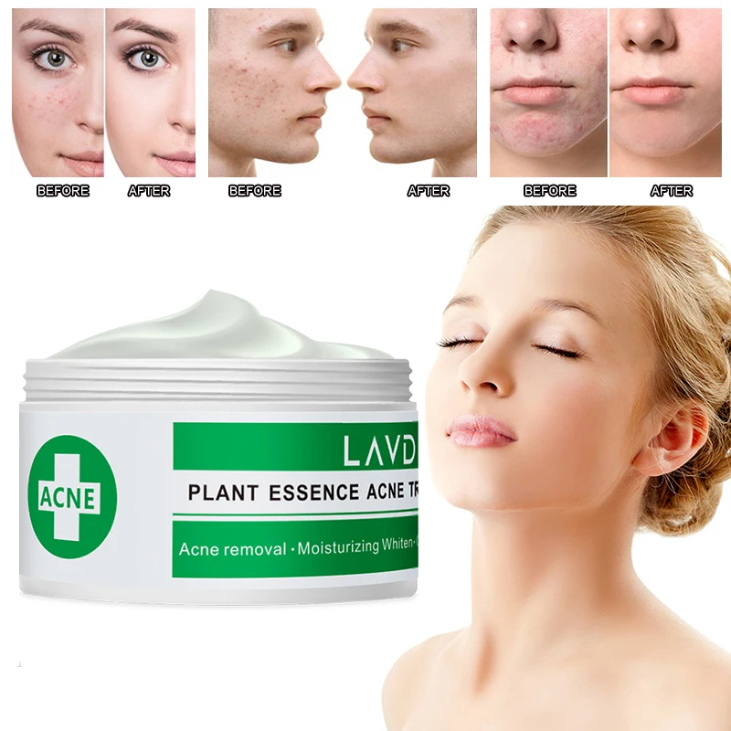 

Plant Extract Acne Cream Wrinkle Whitening Moisturizing Cream Acne Marks Repair Oil Control Shrink Pores Skin Care NEW TSLM1
