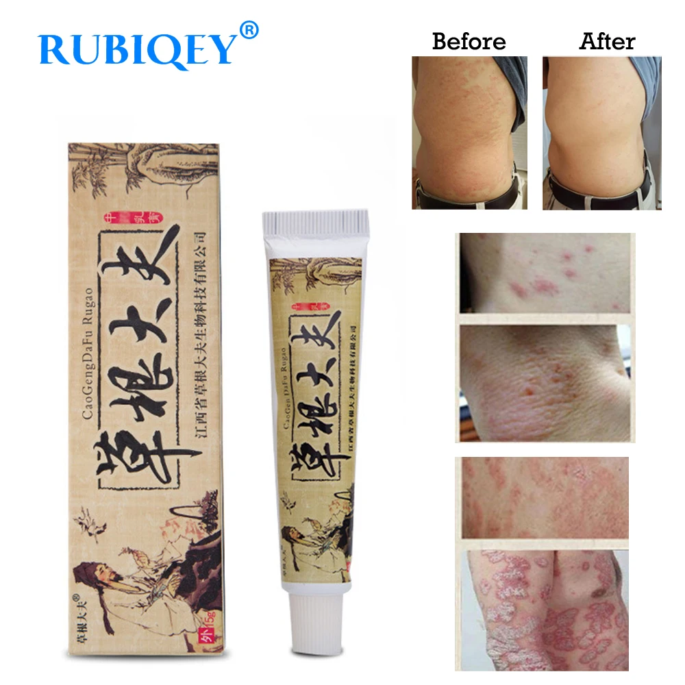 

Body Psoriasis Cream Perfect For Dermatitis and Eczema Pruritus Psoriasis Ointment Herbal Creams RUBIQEY