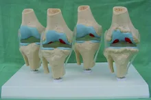 Anatomia anatômica humana degenerativa joelho doença articular esqueleto anatomia crânio osso modelo misturador em trauma esqueleto anatômica