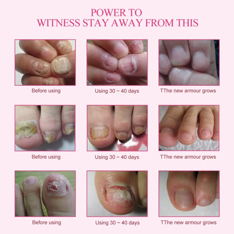 15 г травяные средства для ухода за ногтями ремонт ногтей защита ноги Лечение грибка ногтей