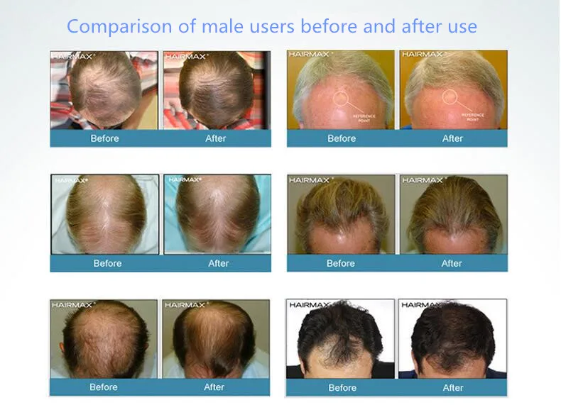 Новинка года волос Восстановление волос лазерный шлем выпадение волос продукты для продажи с очками таймер