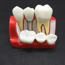4 раза стоматологический имплантат анализ Корона мост демонстрация Стоматологическая модель зубов стоматолога терпение модель