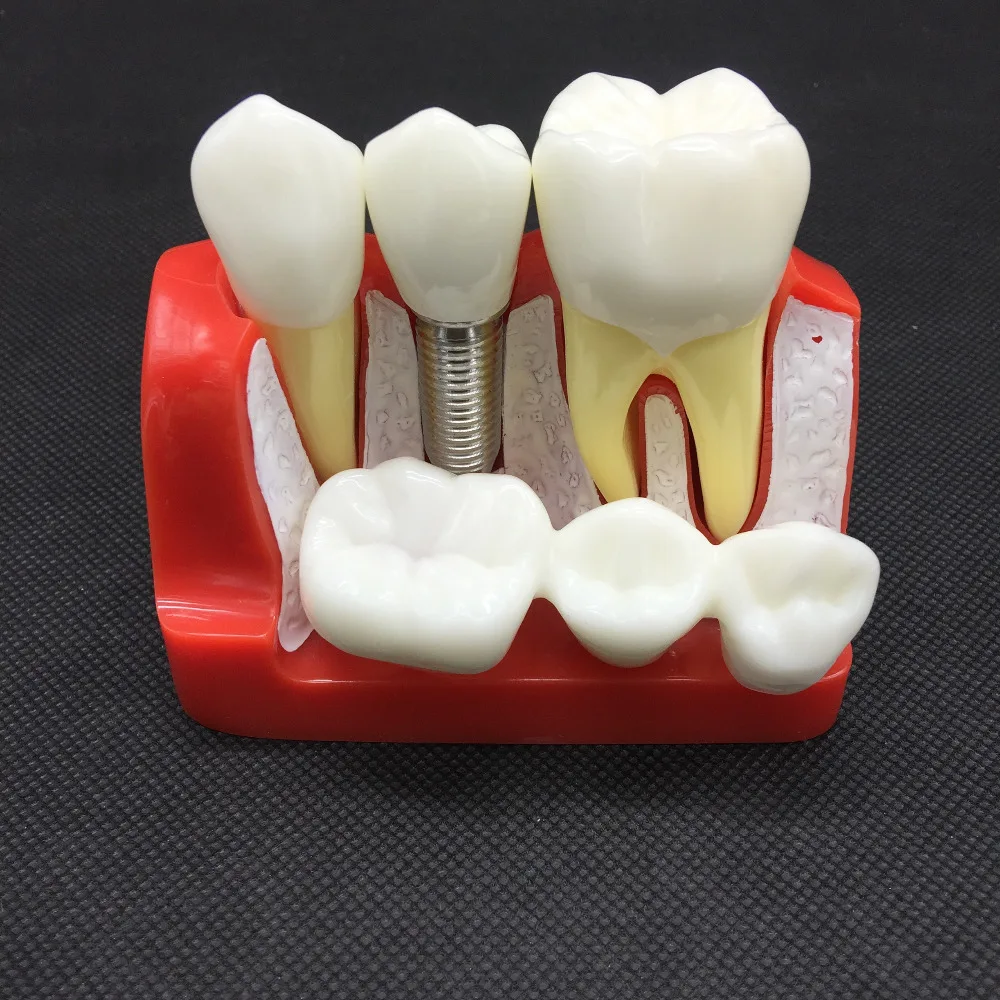 4 Times Dental Implant Analysis Crown Bridge Demonstration Dental Teeth