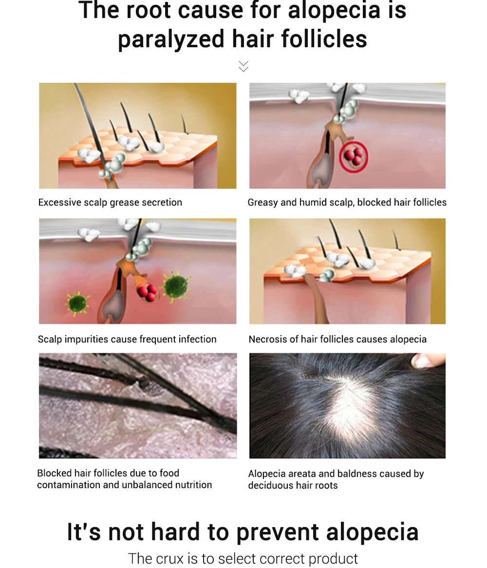 20 мл быстрое мощное средство для роста волос продукты Эфирное Масло жидкое лечение предупреждающий потерю волос уход за волосами восстанавливающая сыворотка