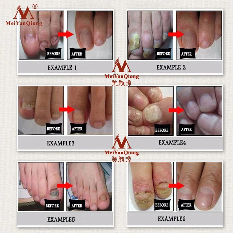 Лечение грибковых ногтей, уход за ногами, эссенция для ногтей, отбеливание ног, удаление грибка ногтей, гель против инфекции, парониксия, онихомикоз