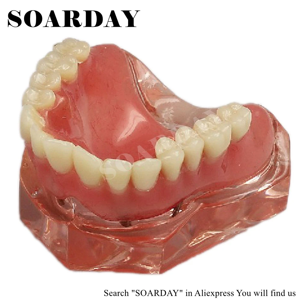 SOARDAY Overdenture низкого качества с 4 импланты с шероховатой поверхностью стоматологический для обучения зуб зубы стоматолог стоматология зубные полоски