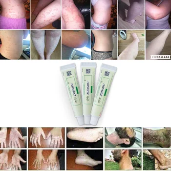 

Hot selling 3PCS ZUDAIFU Body Psoriasis Cream without Retail Box Skin Care