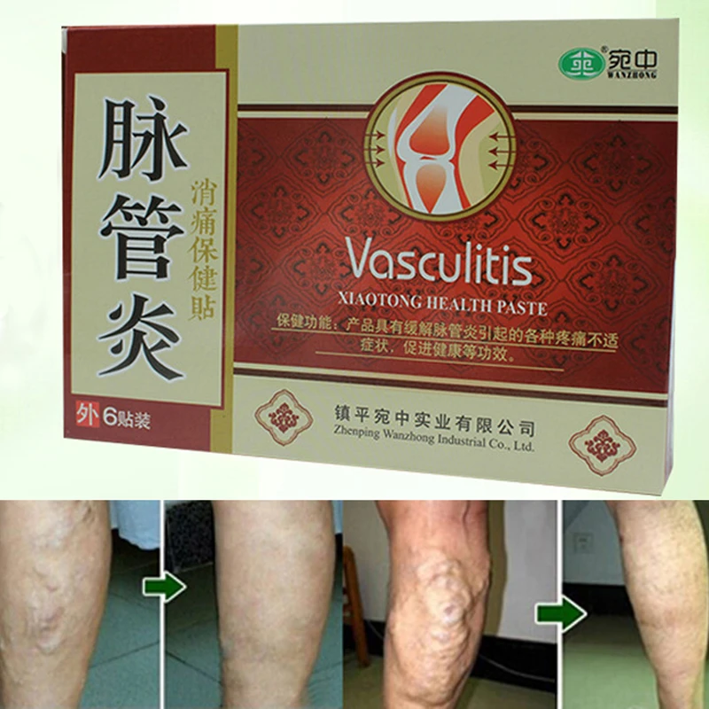 

Varicose Veins Leg Acid Bilges Itching Vasculitis Patch Vasculitis Acid Bilges Itching Patch