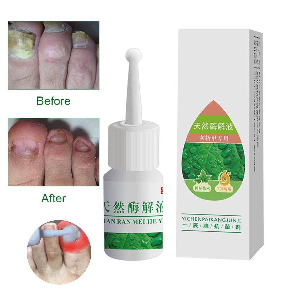 4ml Nail Fungal Treatment Liquid Onychomycosis Removal Anti Fungus Nails Repair Foot Care HS11