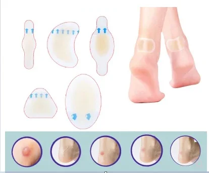 foot blister care