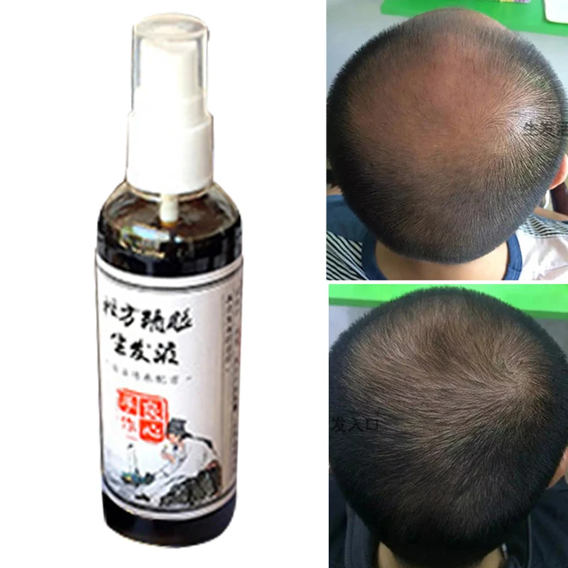 Chinese medicine production growth liquid additional tincture anti Hair