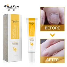 Kills 99.9% Bacteria Nail Treatment Cream Feet Care Repair Nails Foot Anti Fungus Gel Paronychia Onychomycosis Nail Infection