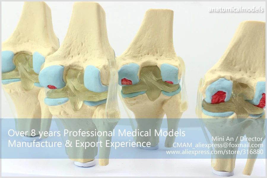 12359/человека 4-х ступенчатый остеоартрит колена комплект совместное Исследование модели, медицинские товары образования анатомические модели