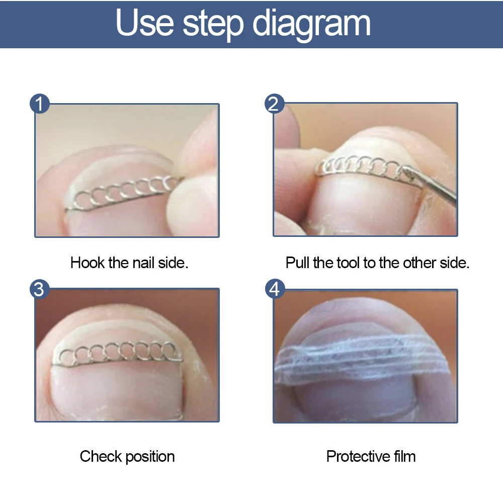12 шт. в упаковке, PovihomeToe коррекция ногтей провода устройство фиксации для педикюра паронихии восстановить персонифицированный фен защита ноги C1509