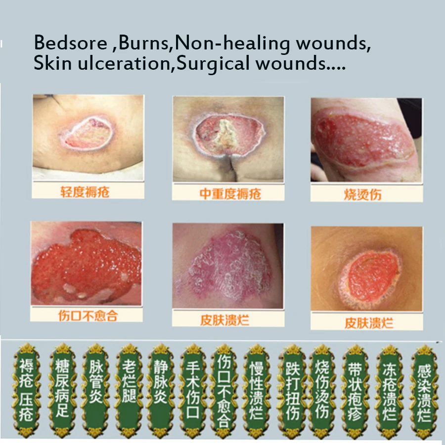 Ulcer Festering Sores/decubituses/pressure Removal Herbal 1 Ulcer Festering Sores/decubituses/pressure Removal Herbal 1