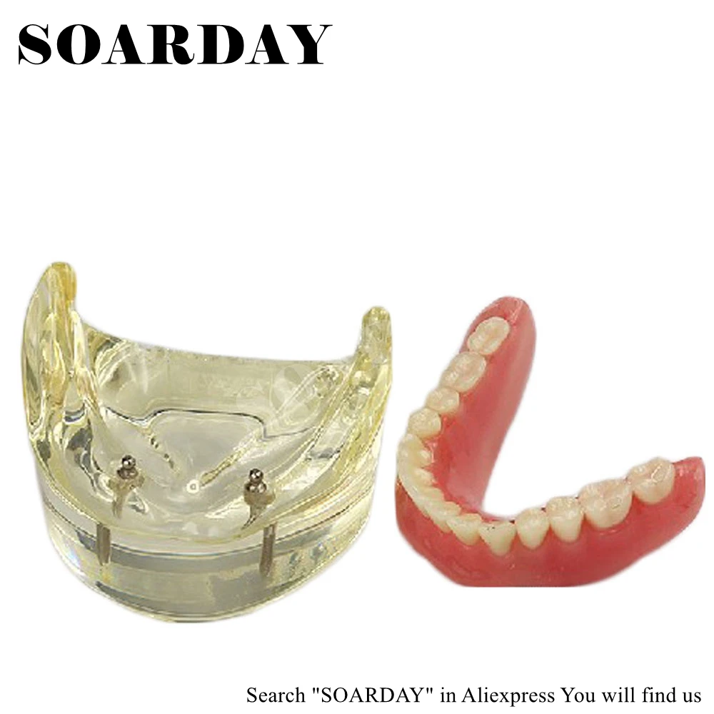 SOARDAY съемные нижние зубные протезы нижняя с 2 имплантатами демонстрация зубов