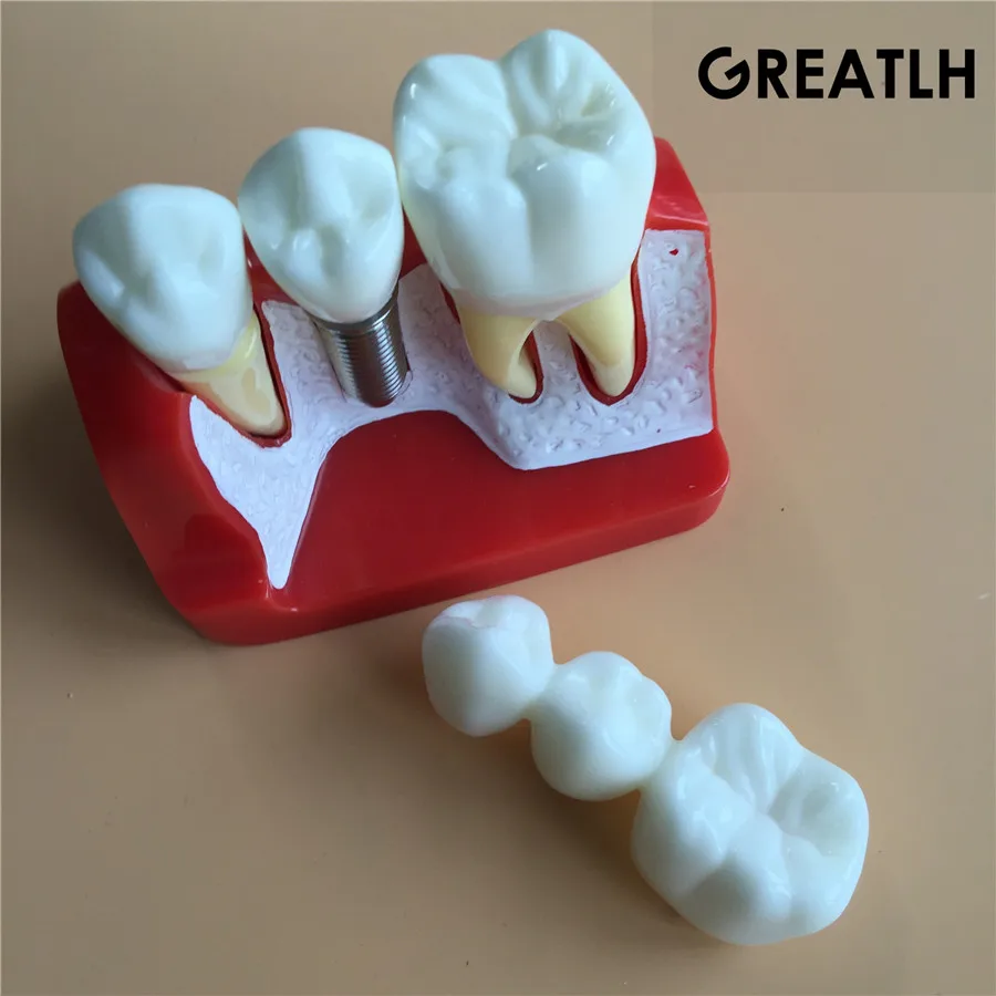 

Dental Teach-Study Model Implant Analysis Crown Bridge Demonstration Teeth Model