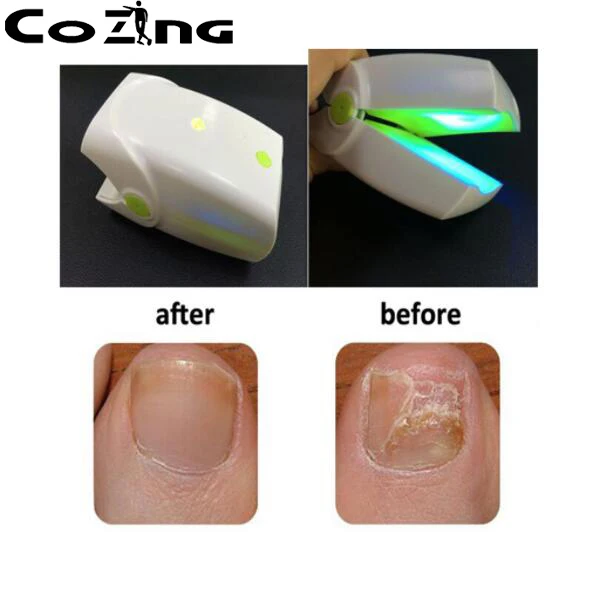 

905nm 470nm Nail Fungus Onychomycosis laser Treatment Instrument Anti-Fungal laser device leuconychia ringworm of the nail LLLT