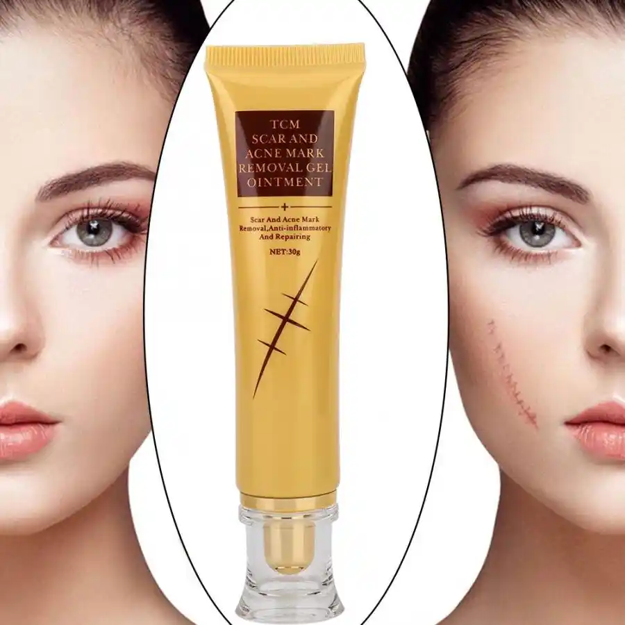cream to remove acne scars on face