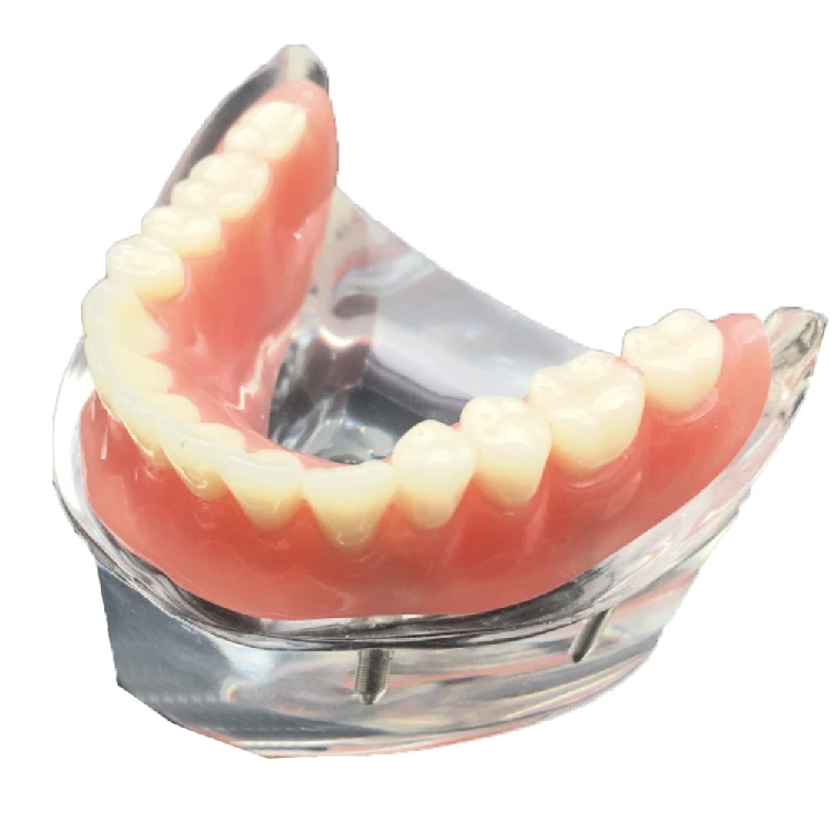 

Poseida 1pc Dental Implant Model New Planting And Repair Model Teaching Dental Material