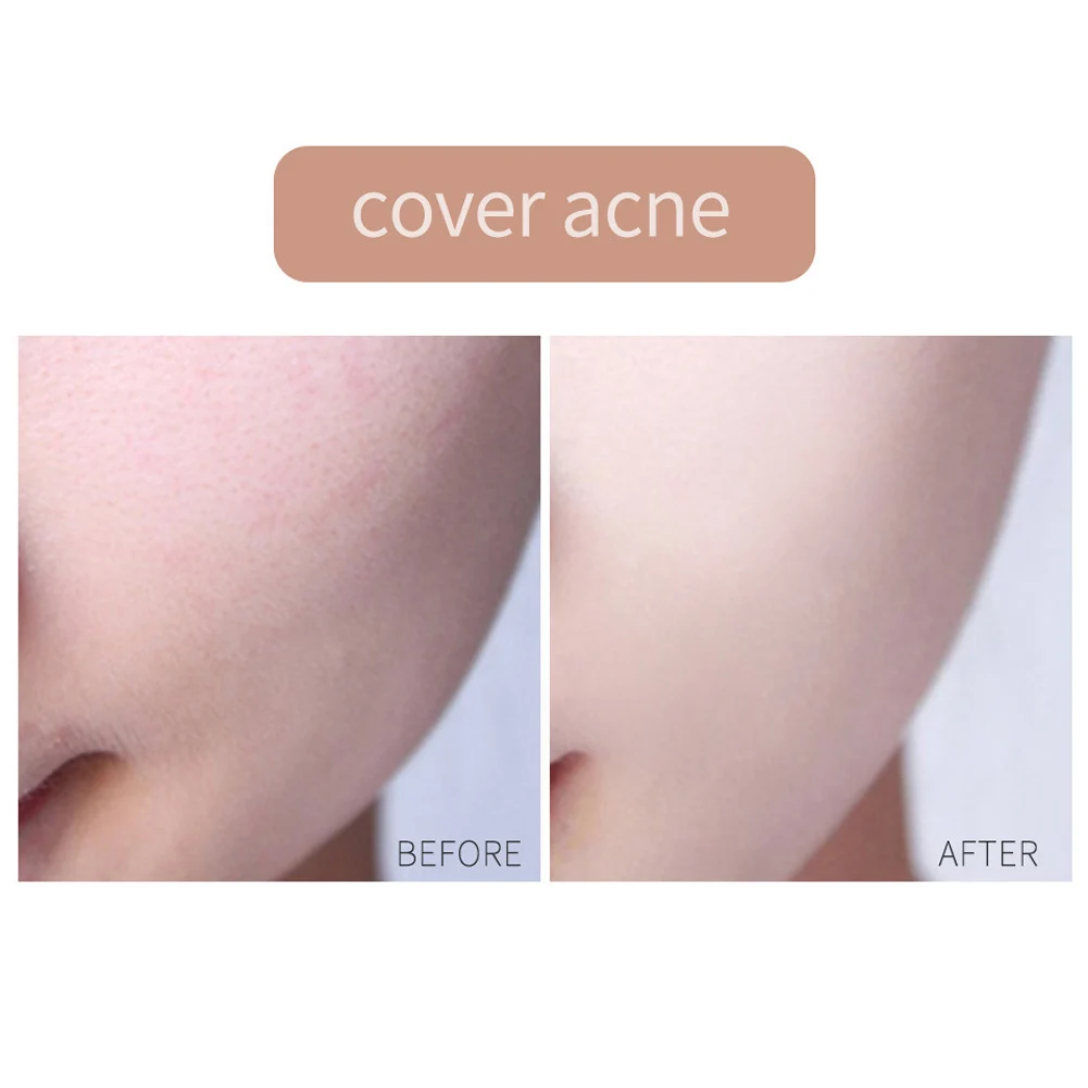 acne friendly concealer