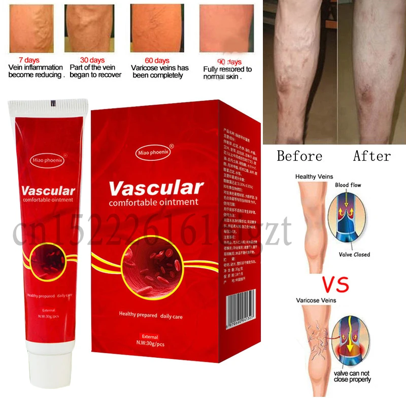 

Ultra Strength Varicose Veins Treatment Cream Vasculitis Phlebitis Spider Veins Pain Varicosity Angiitis Remedy Removal Cream