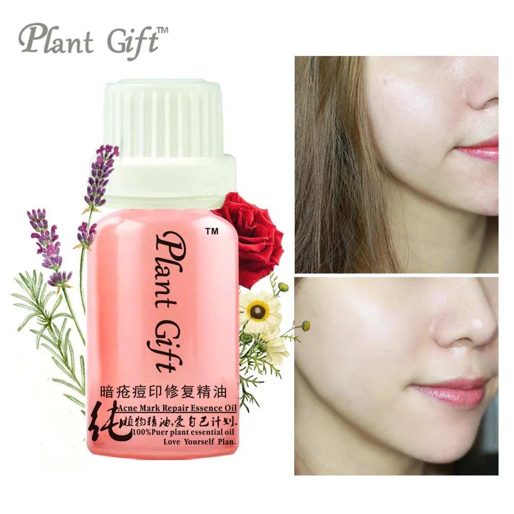 

100% Compound Essential Oil Acne Mark Repair Essence Oil Pimple Sedation, Anti-inflammatory, Anti-acne India Lavender, rose