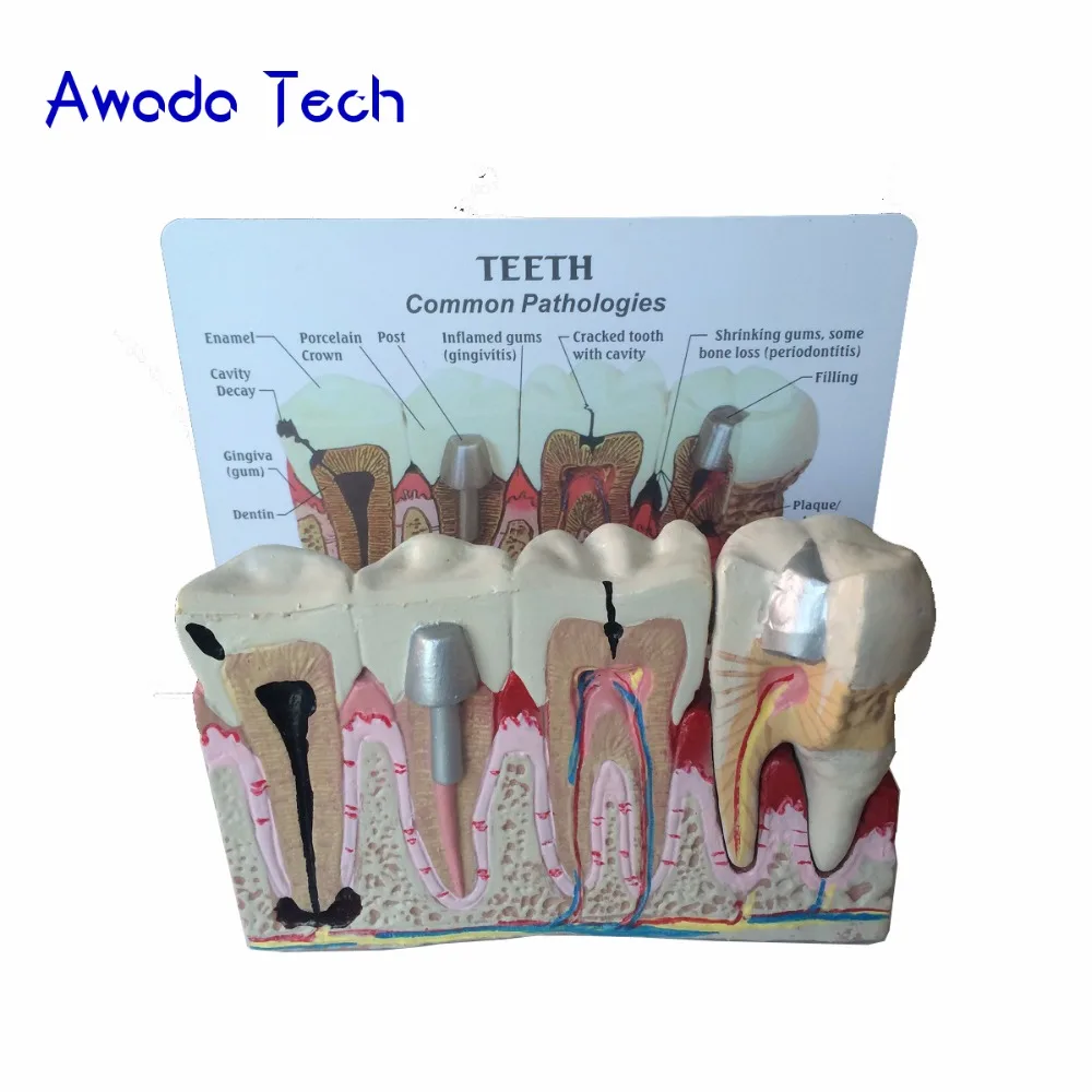 

AwadaTech Dental teeth common pathologies teaching model ,Teeth Whitening Tooth Dentist for Medical Science Teaching