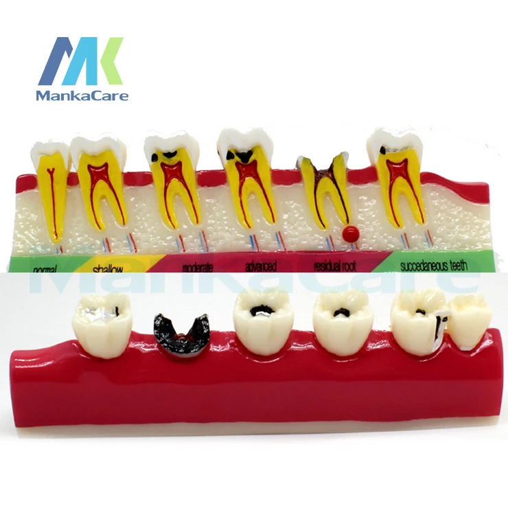Стоматологическая модель периодонтальное заболевание Assort Tooth Типографа 2 типа