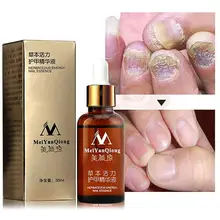 Уход за ногами Лечение ногтей от грибка Уход за ногами эссенция для ногтей Удаление грибка гель анти-инфекция Paronychia Onychomycosis