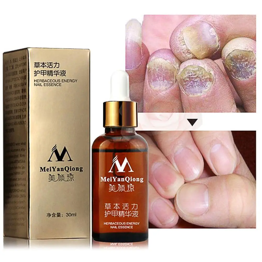 

Foot Care Fungal Nail Treatment Feet Care Essence Nail Toe Fungus Removal Gel Anti Infection Paronychia Onychomycosis