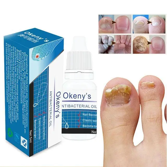 5ml Removal Onychomycosis Toe Nail Fungus Repair Anti Fungal Nail