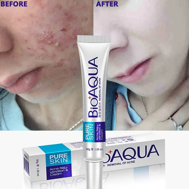 cream for acne and scars